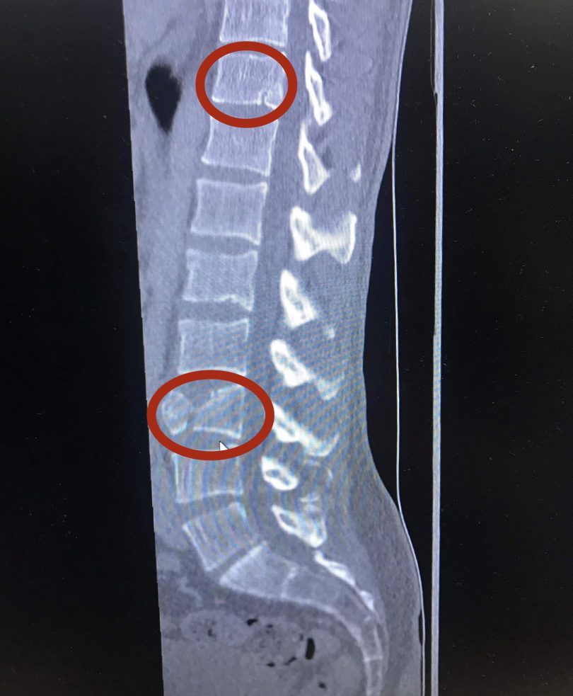 X-ray showing Will's fractured spine.